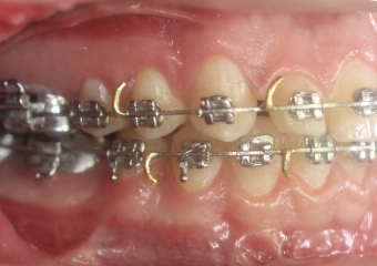 Mordida após a cirurgia - Clínica Cliniface