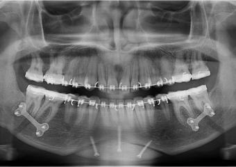 Raio X após cirurgia - Clínica Cliniface