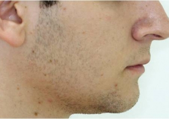 Perfil após a cirurgia - Clínica Cliniface