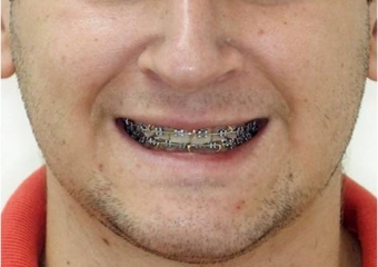 Sorriso após a cirurgia - Clínica Cliniface