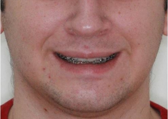 Sorriso inicial - Clínica Cliniface