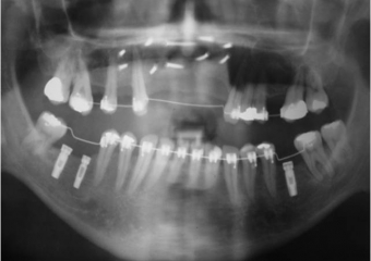 Raio X dos implantes inferiores - Clínica Cliniface