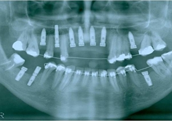 Raio X dos implantes superiores - Clínica Cliniface