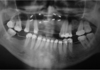 Raio X do enxerto ósseo anterior e levantamento de seio maxilar, com osso de ilíaco - Clínica Cliniface