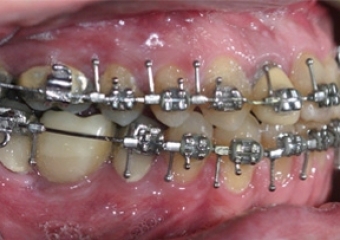 Mordida após a cirurgia - Clínica Cliniface