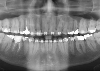 Raio X após mesialização da raiz do dente 22 - Clínica Cliniface