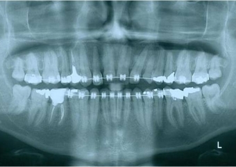 Raio X com raiz do dente 22 distalizada - Clínica Cliniface