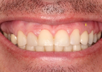 Sorriso final do caso terminado em janeiro de 2013 - Clínica Cliniface