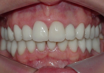 Imagens com facetas e prótese fixa em porcelana sobre implante - Clínica Cliniface