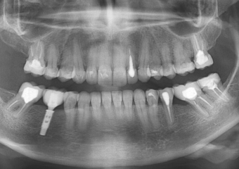 Raio X com prótese fixa em porcelana sobre implante Cone Morse - Clínica Cliniface