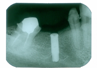 Raio X do implante - Clínica Cliniface
