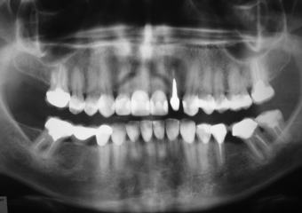 Raio X inicial apresentando ausência do molar inferior direito - Clínica Cliniface