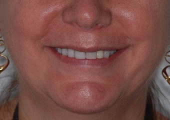 Sorriso inicial - Clínica Cliniface