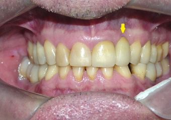  Prótese fixa em porcelana sobre implante Cone Morse - Clínica Cliniface