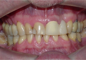 Imagens iniciais, mostrando ausência do elemento 22 - Clínica Cliniface