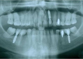 Raio X das próteses fixas em porcelana - Clínica Cliniface