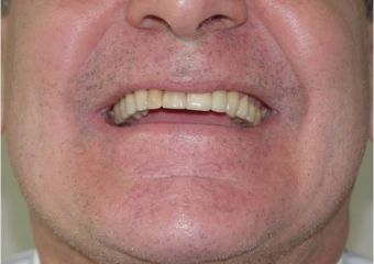 Imagem final, do caso terminado em fevereiro de 2013 - Clínica Cliniface