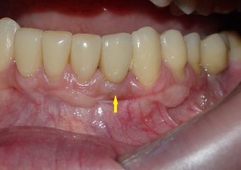 Imagem do caso finalizado em maio de 2012 - Clínica Cliniface