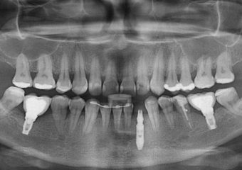 Raio X com próvisório já instalado sobre o implante cone morse - Clínica Cliniface