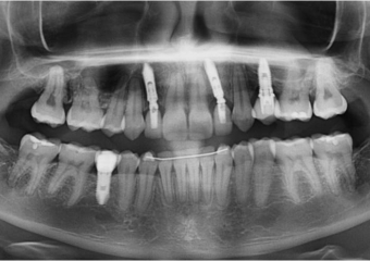 Raio X final com próteses em porcelana  sobre implantes - Clínica Cliniface