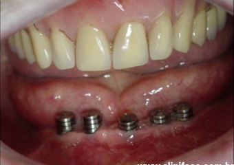 Implantes com cicatrizadores - Clínica Cliniface