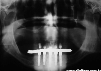Raio X com prótese fixa instalada - Clínica Cliniface
