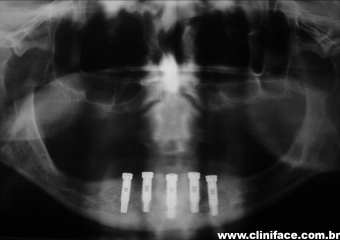 Raio X com implantes instalados - Clínica Cliniface