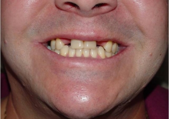 Sorriso inicial - Clínica Cliniface