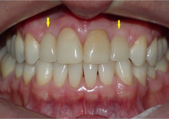 Próteses em porcelana - Clínica Cliniface