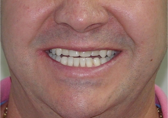 Sorriso final, do caso terminado em julho de 2012 - Clínica Cliniface