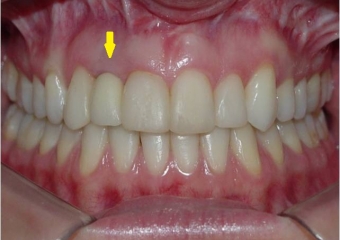 Imagem do caso após remoção do aparelho e instalação de prótese sobre implante em porcelana - Clínica Cliniface