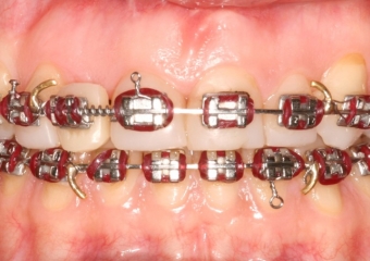 Imagem após cirurgia ortognática - Clínica Cliniface