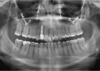 Raio X do implante cone Morse e prótese fixa em porcelana - Clínica Cliniface