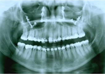Raio X após cirurgia ortognática de avanço de maxila - Clínica Cliniface