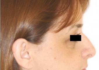 Perfil após cirurgia ortognática - Clínica Cliniface