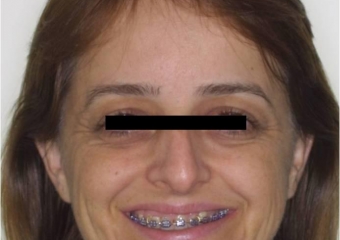 Sorriso inicial - Clínica Cliniface