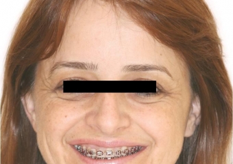 Sorriso após cirurgia ortognática - Clínica Cliniface