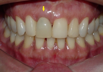Prótese provisória fixa sobre implante cone Morse - Clínica Cliniface