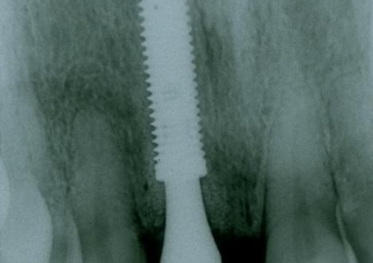 Implante instalado imediatamente após extração - Clínica Cliniface