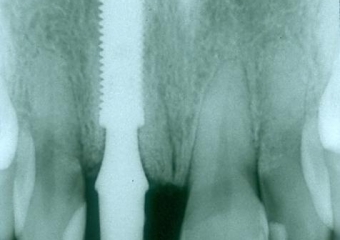 Raio X da prótese provisória - Clínica Cliniface