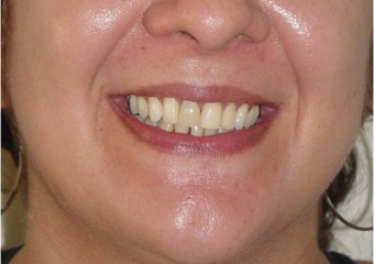 Sorriso após prótese provisória instalada - Clínica Cliniface
