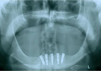 Raio X após instalação de 05 implantes na mandíbula - Clínica Cliniface