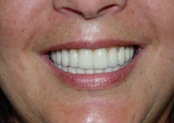 Sorriso final do caso terminado em outubro de 2012 - Clínica Cliniface