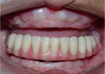 Prótese fixa provisória inferior - Clínica Cliniface