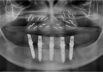 Raio X do enxerto ósseo na maxila com osso de calota craniana - Clínica Cliniface
