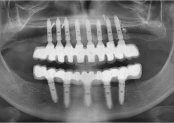 Raio X  final das próteses fixas em porcelana - Clínica Cliniface