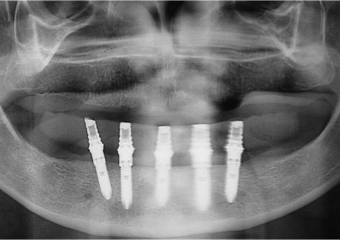Raio X dos implantes inferiores - Clínica Cliniface