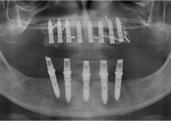Raio X dos implantes Cone Morse superiores - Clínica Cliniface