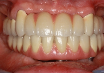 Próteses fixas em porcelana superior e inferior sobre implantes Cone Morse - Clínica Cliniface