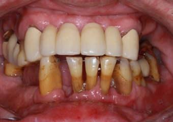 Imagem inicial com vários dentes comprometidos - Clínica Cliniface